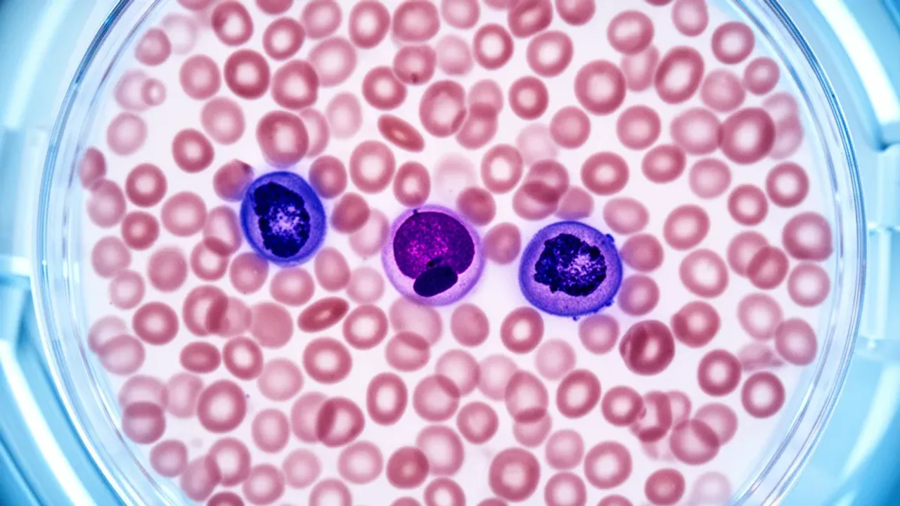 Poziom bazofili przy białaczce: co oznacza w morfologii krwi?